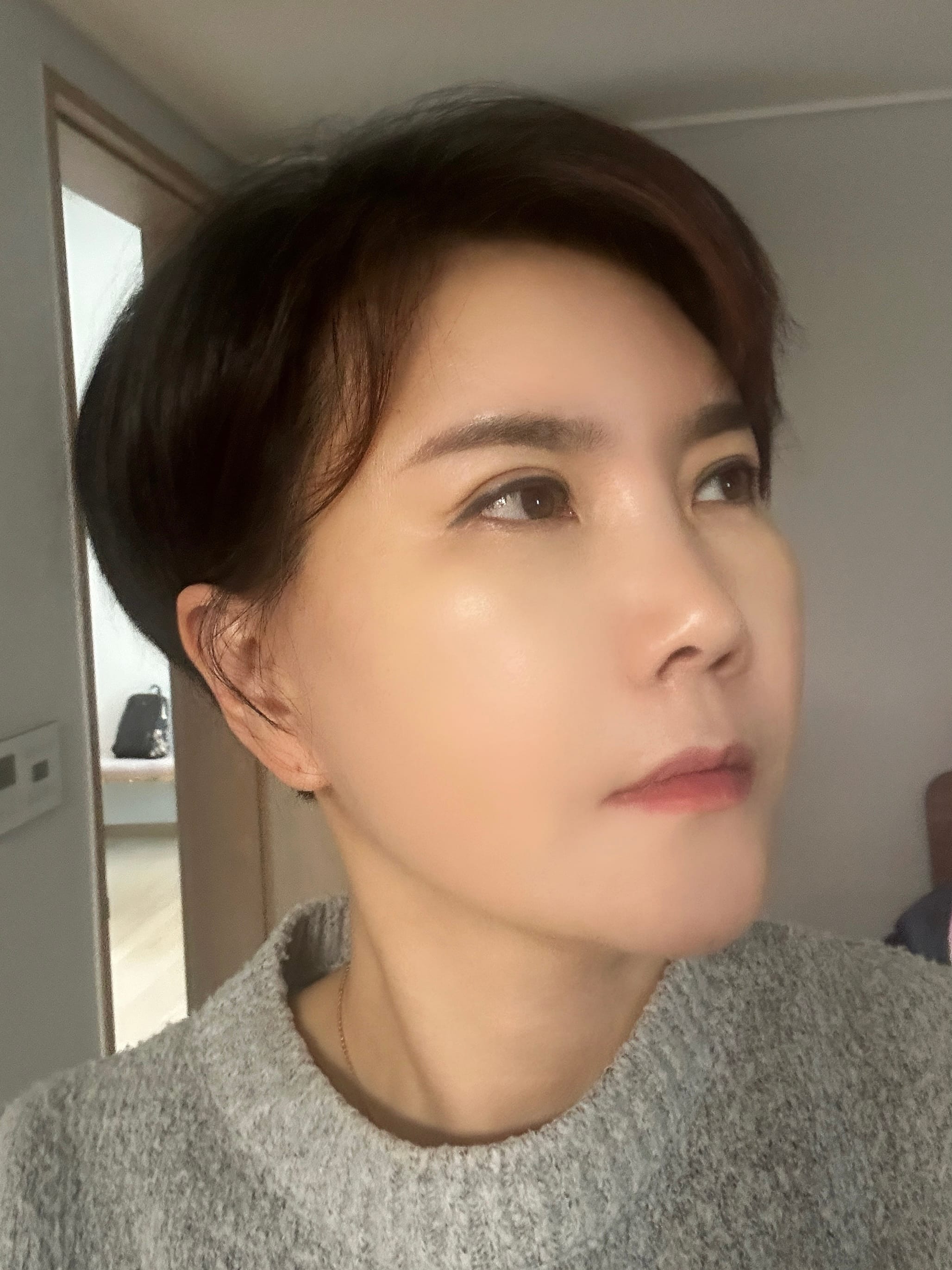 미니거상 수술 후