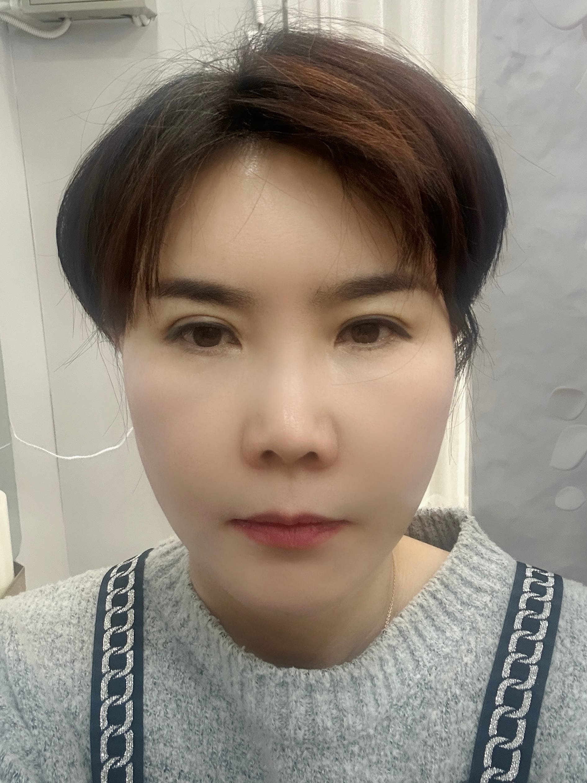 미니거상 수술 후