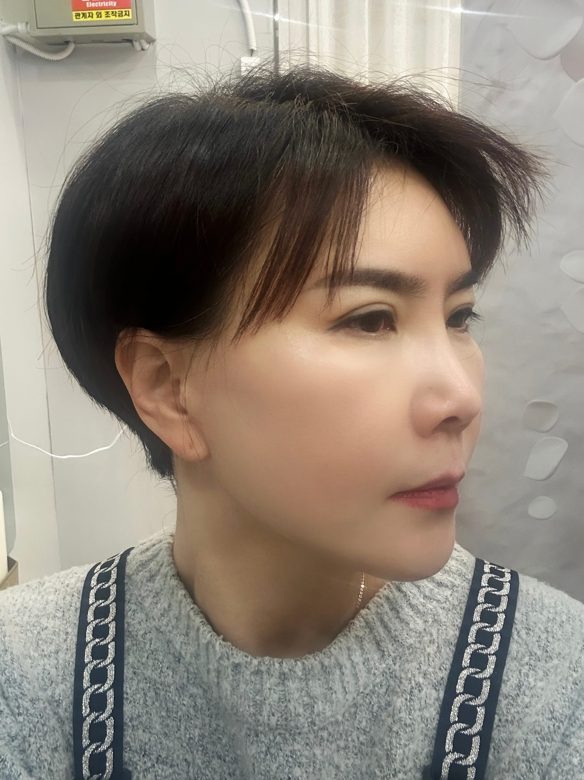 미니거상 수술 후