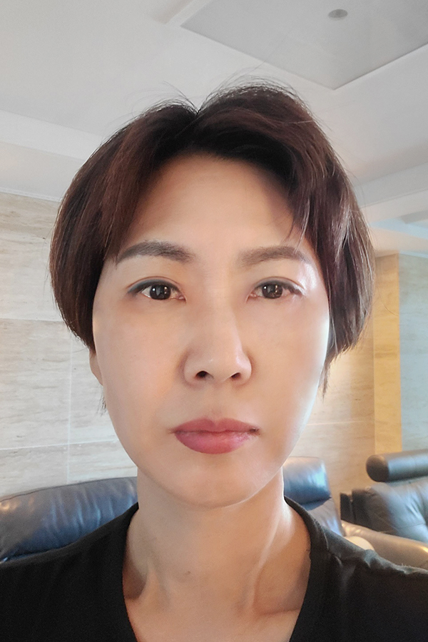 안면거상 수술 후