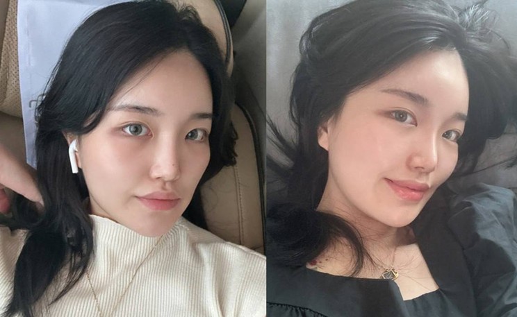 얼굴지방흡입 수술 후