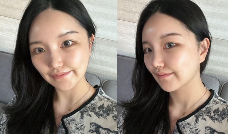 얼굴지방흡입 수술 후
