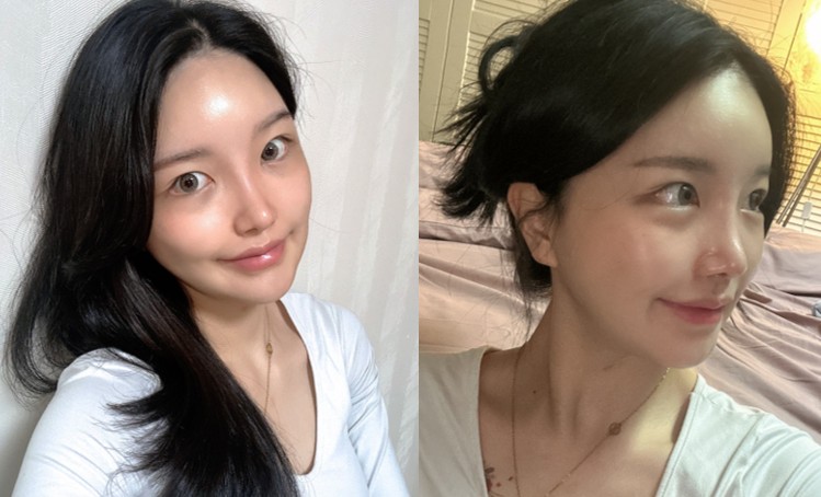 얼굴지방흡입 수술 후