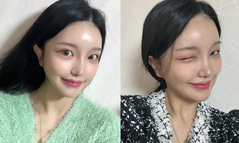 얼굴지방흡입 수술 후