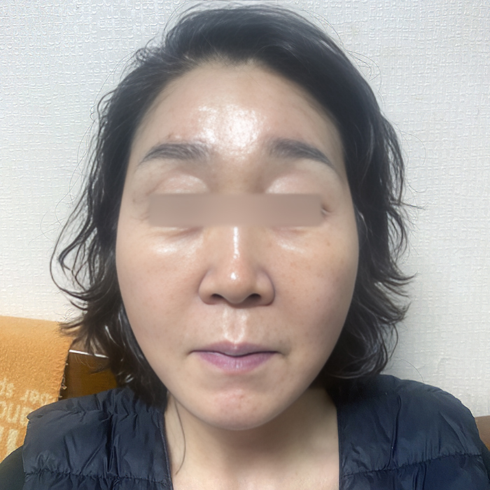 안면거상 수술 후