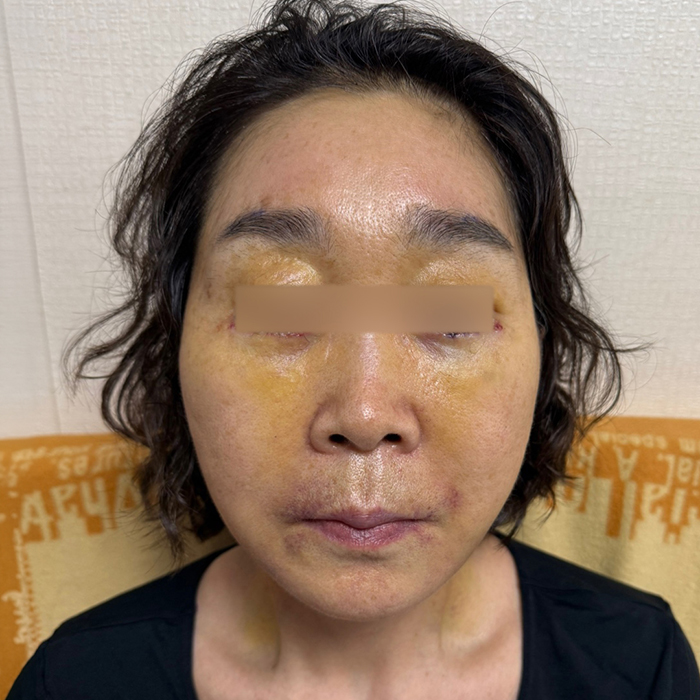 안면거상 수술 후