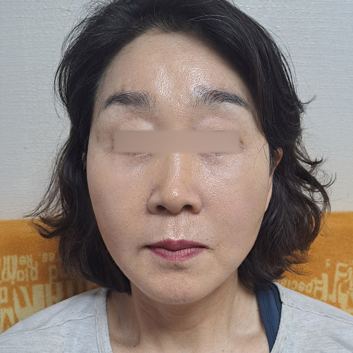 안면거상 수술 후