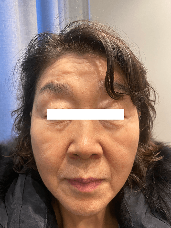 안면거상 수술 전