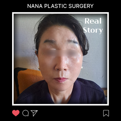레이저·실리프팅으로 안 되던 탄력, 안면거상으로 잡은 턱선 후기 썸네일
