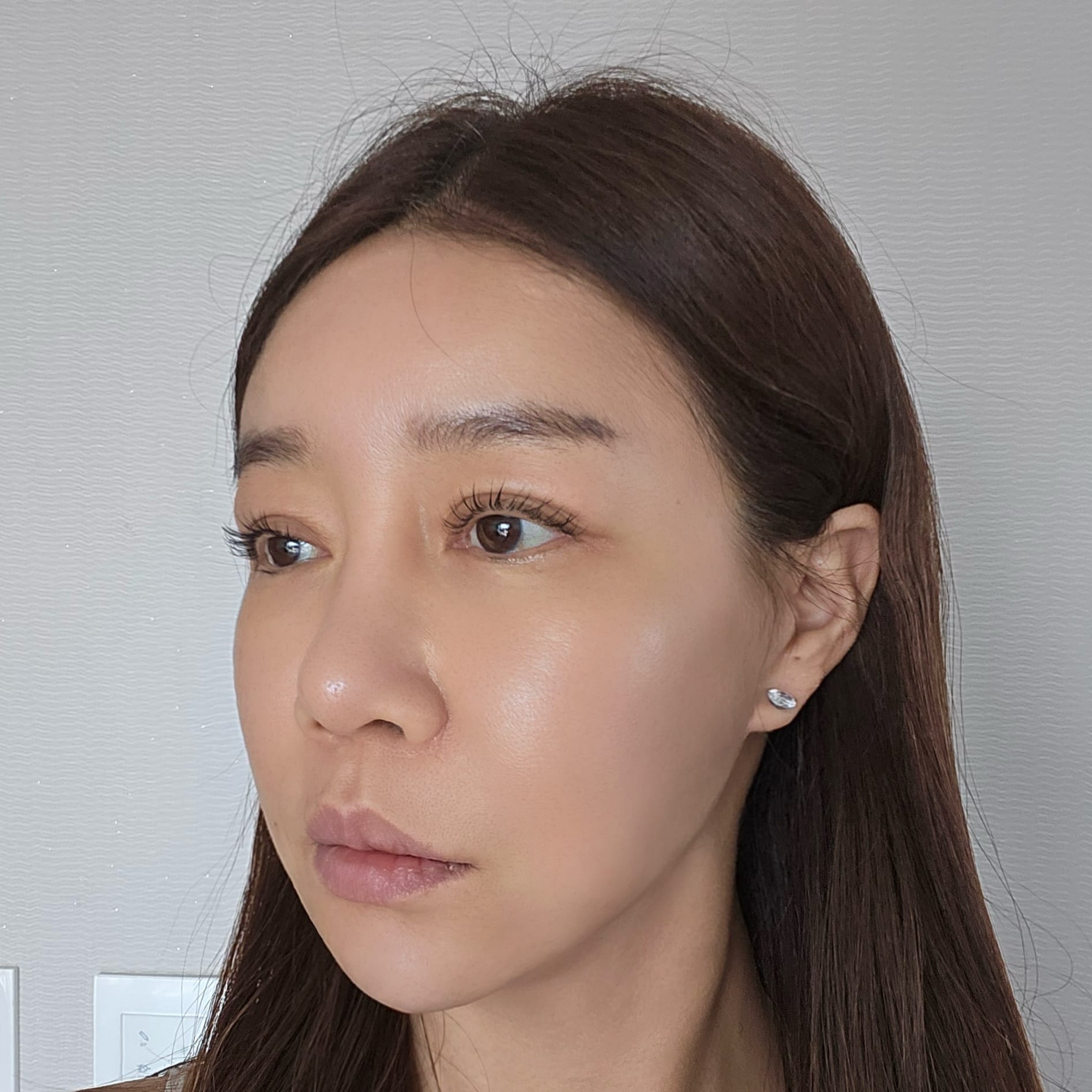 안면거상 수술 후