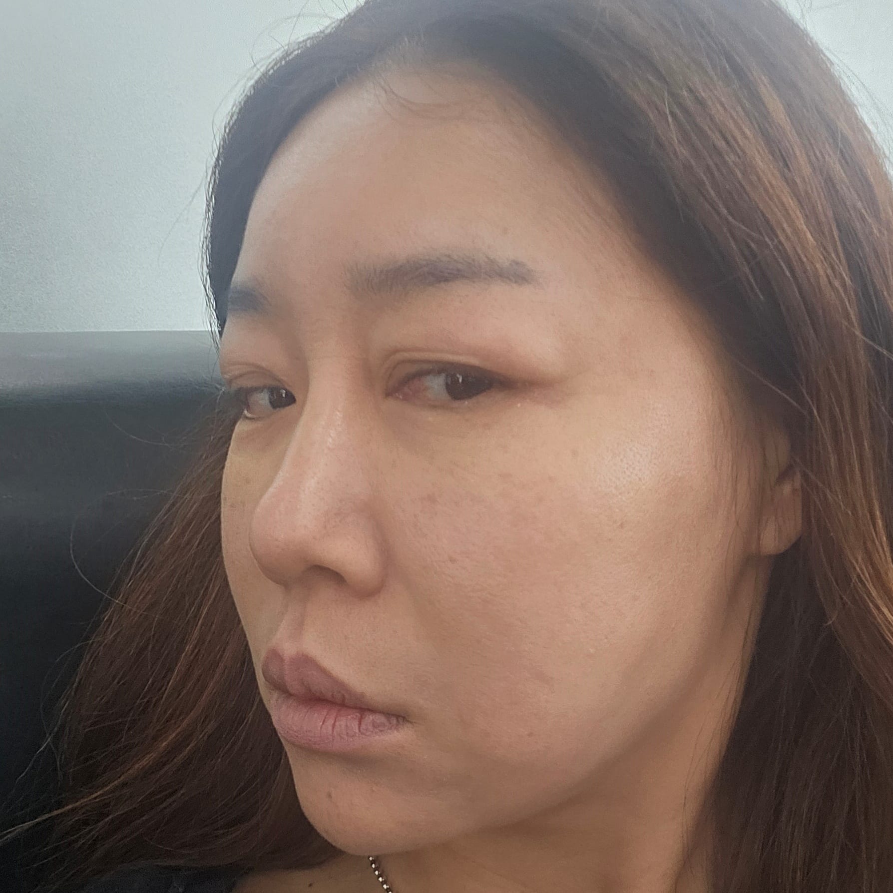 안면거상 수술 전