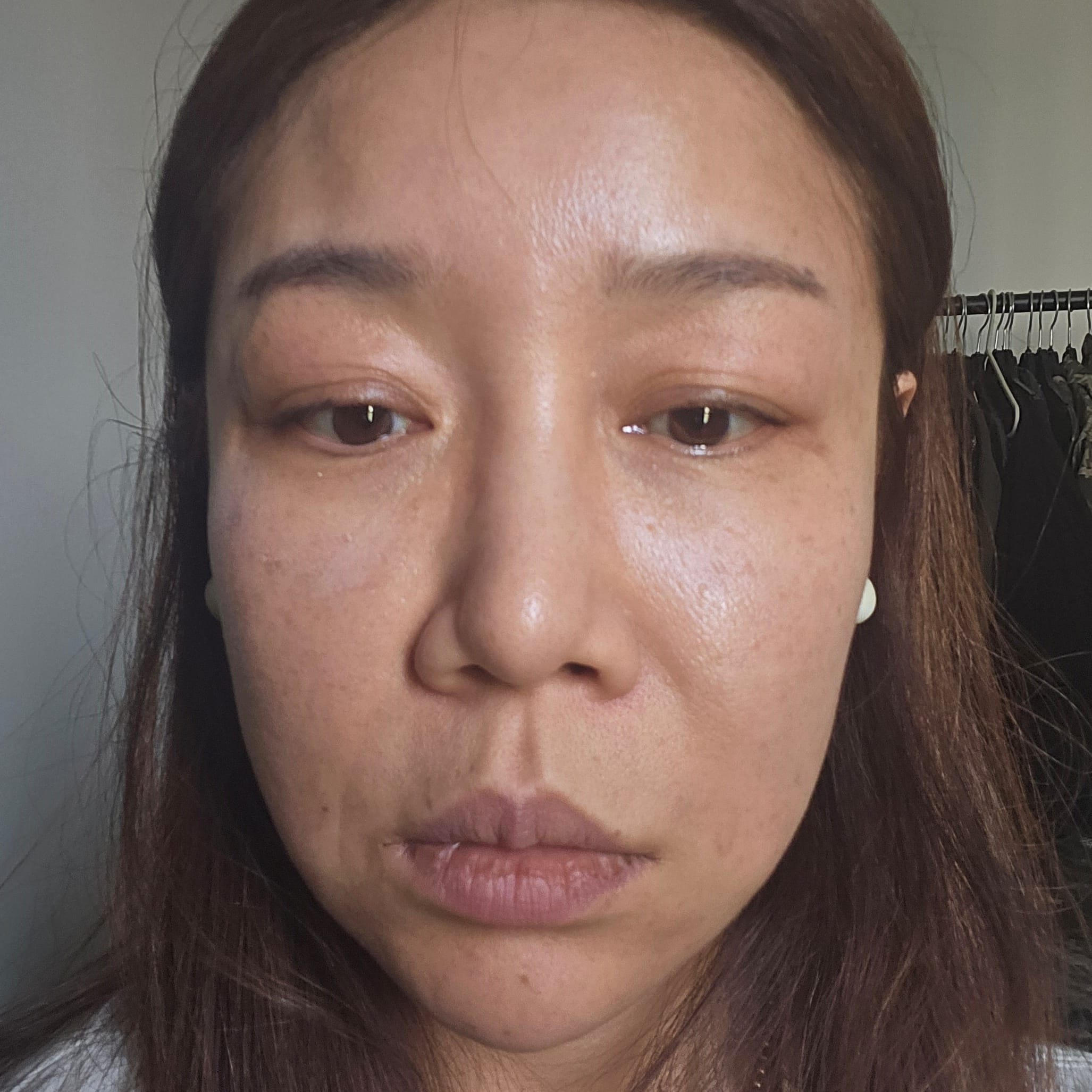 안면거상 수술 전