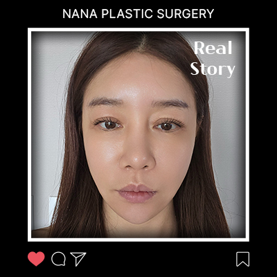 깊어진 팔자와 처진 입가, 안면거상으로 되찾은 40대 인상 후기 썸네일
