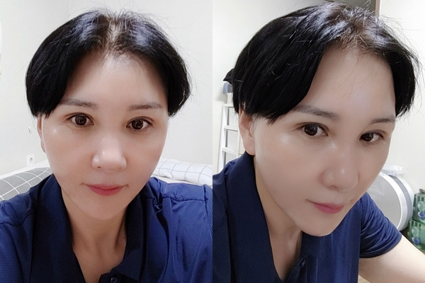 미니거상, 상안검 수술 후