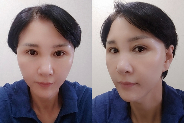 미니거상, 상안검 수술 후