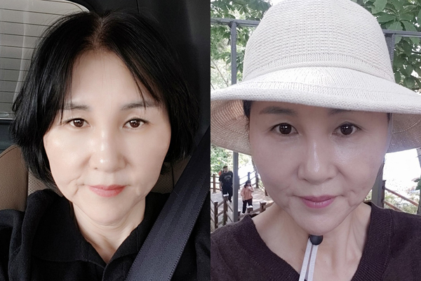 미니거상, 상안검 수술 전