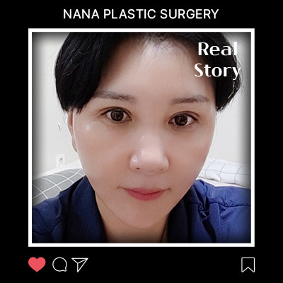 미니거상·상안검 리얼후기 썸네일