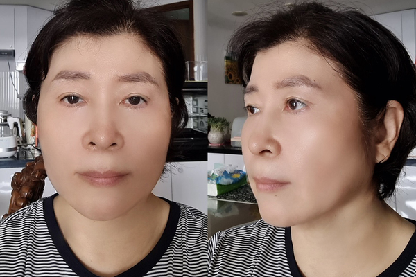 민트실, 상안검, 하안검, 지방제거 수술 후