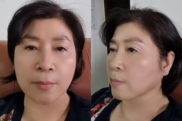 민트실, 상안검, 하안검, 지방제거 수술 후