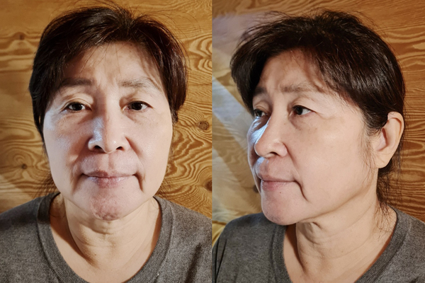 민트실, 상안검, 하안검, 지방제거 수술 전