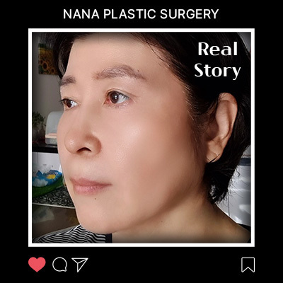 민트실·상안검·하안검·지방제거 리얼후기 썸네일