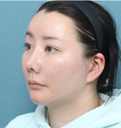 AFTER 45도