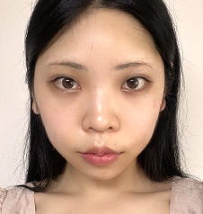 수술 전