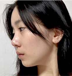 BEFORE 측면