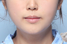 수술 후
