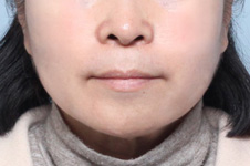 수술 후