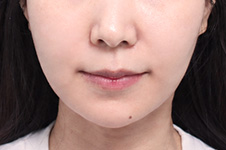 수술 후